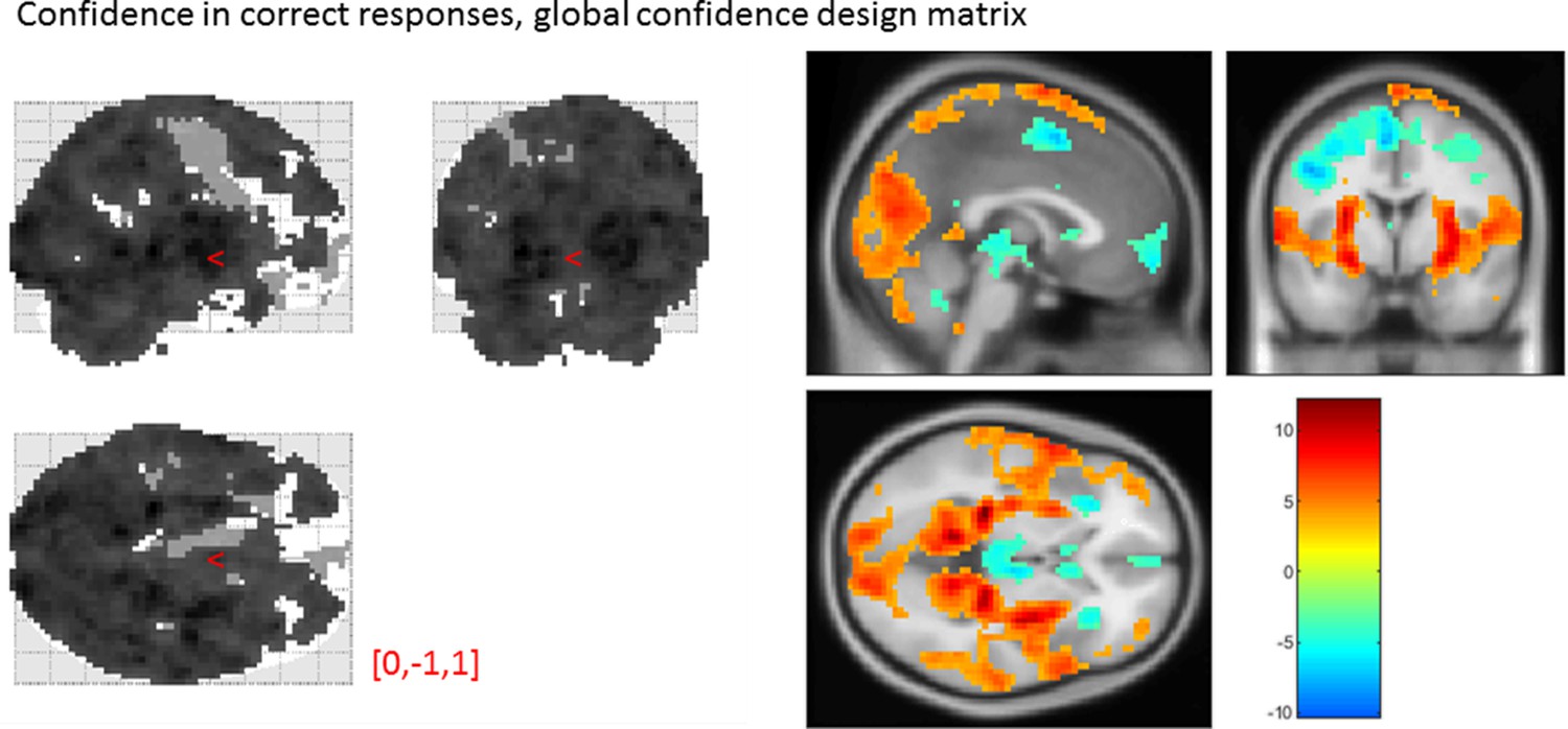Effect of confidence in correct responses, from the global-confidence design matrix. Uncorrected, thresholded at p<0.001. Left: glass brain visualization of the whole brain contrast. Right: yellow-red represent a positive correlation with subjective confidence ratings, and green-blue represent a negative correlation.